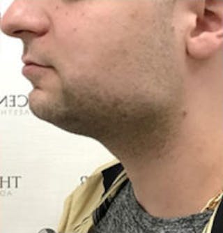 Facetite / Necktite / Embrace / Accutite Before & After Gallery - Patient 157140374 - Image 4