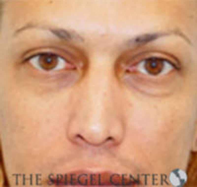 Rhinoplasty Before & After Gallery - Patient 157140384 - Image 3