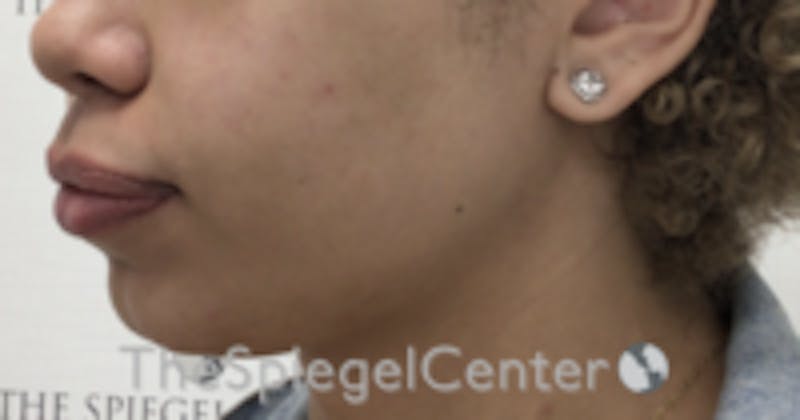 Chin Filler Before & After Gallery - Patient 157140381 - Image 4