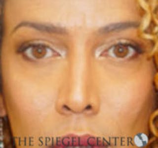 Rhinoplasty Before & After Gallery - Patient 157140384 - Image 4