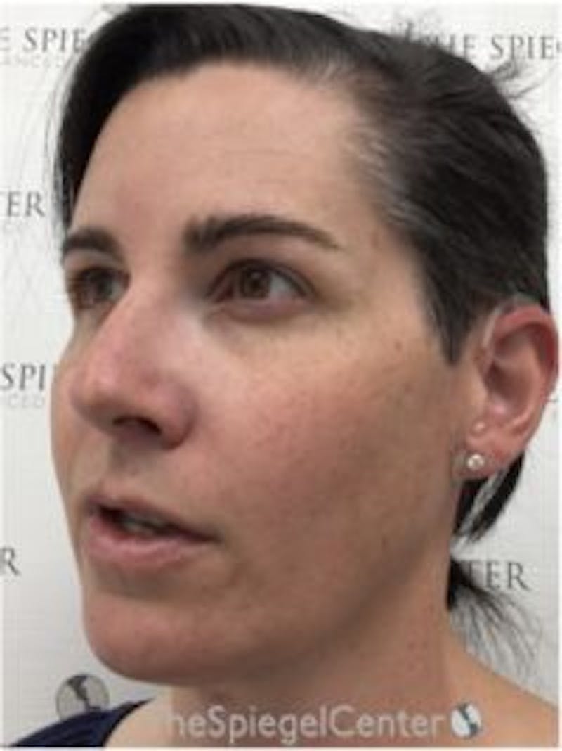FFS Before & After Gallery - Patient 157140380 - Image 4