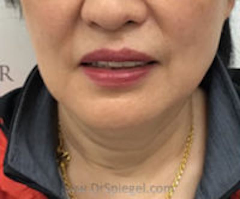 Facetite / Necktite / Embrace / Accutite Before & After Gallery - Patient 157140388 - Image 1