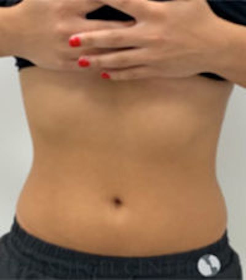 Fat Freezing Before & After Gallery - Patient 157140387 - Image 2