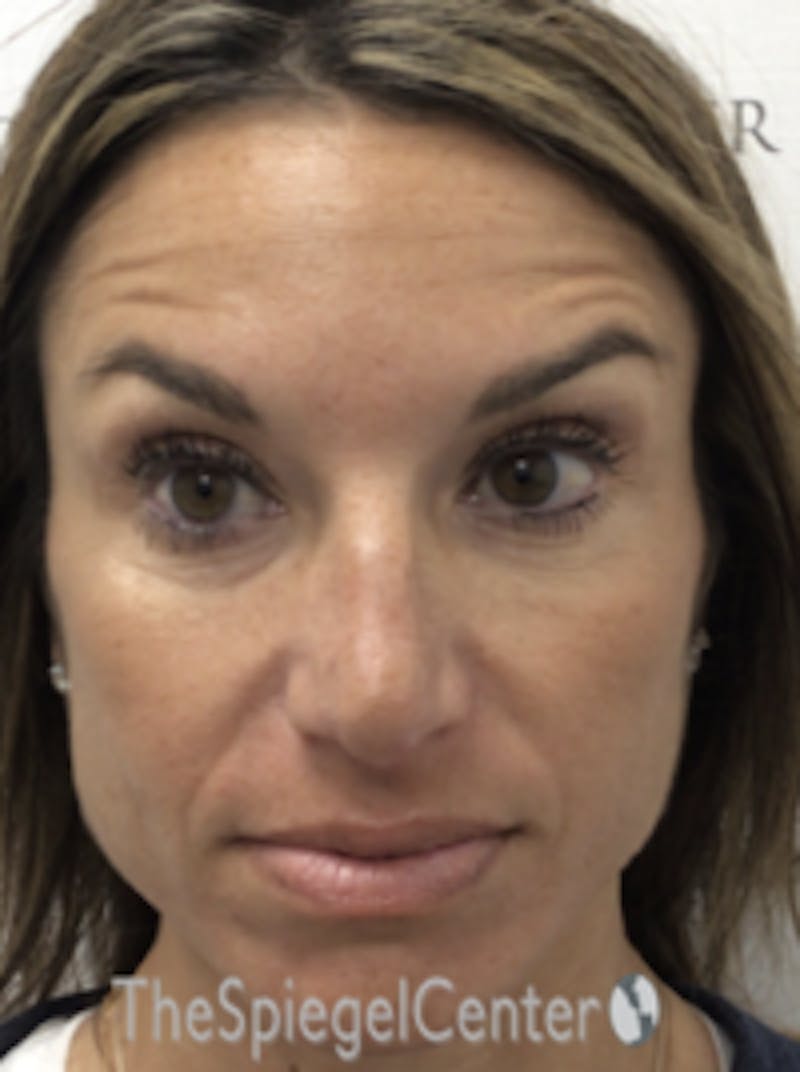 Botox / Dysport / Jeuveau / Xeomin Before & After Gallery - Patient 157140392 - Image 4