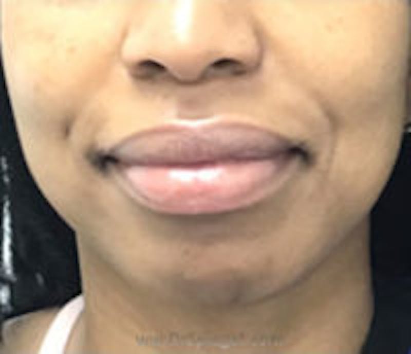 Chin Filler Before & After Gallery - Patient 157140393 - Image 1