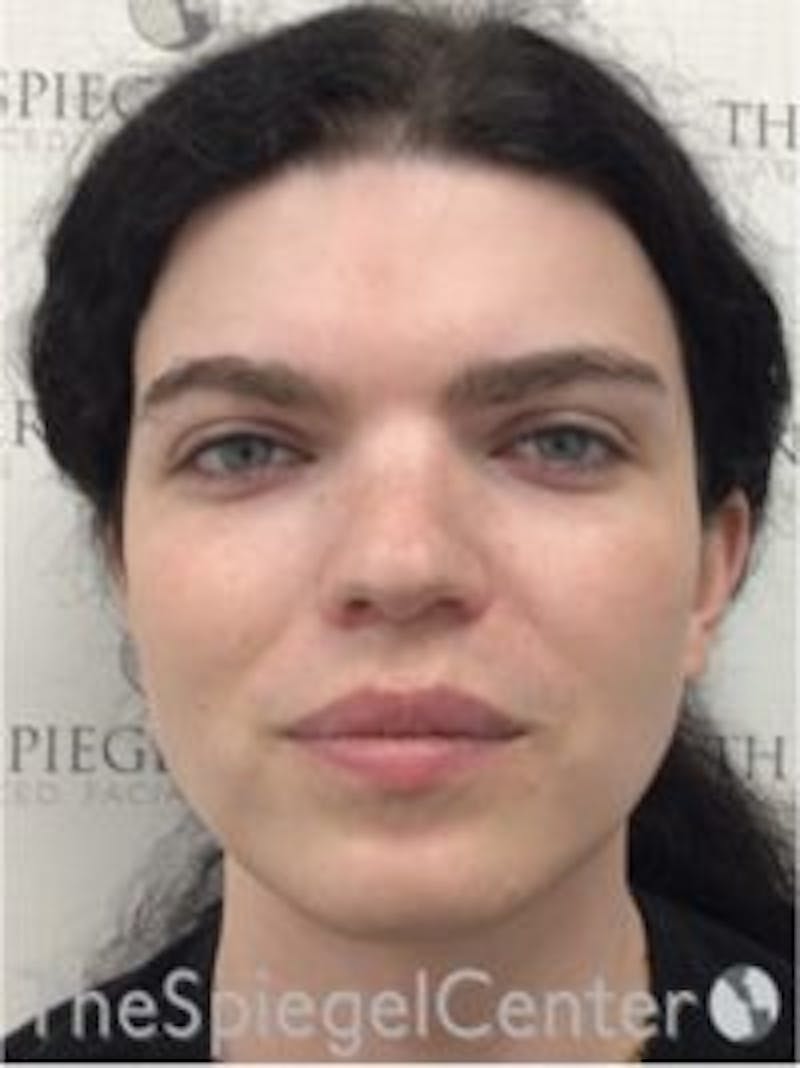 FFS Before & After Gallery - Patient 157140394 - Image 1