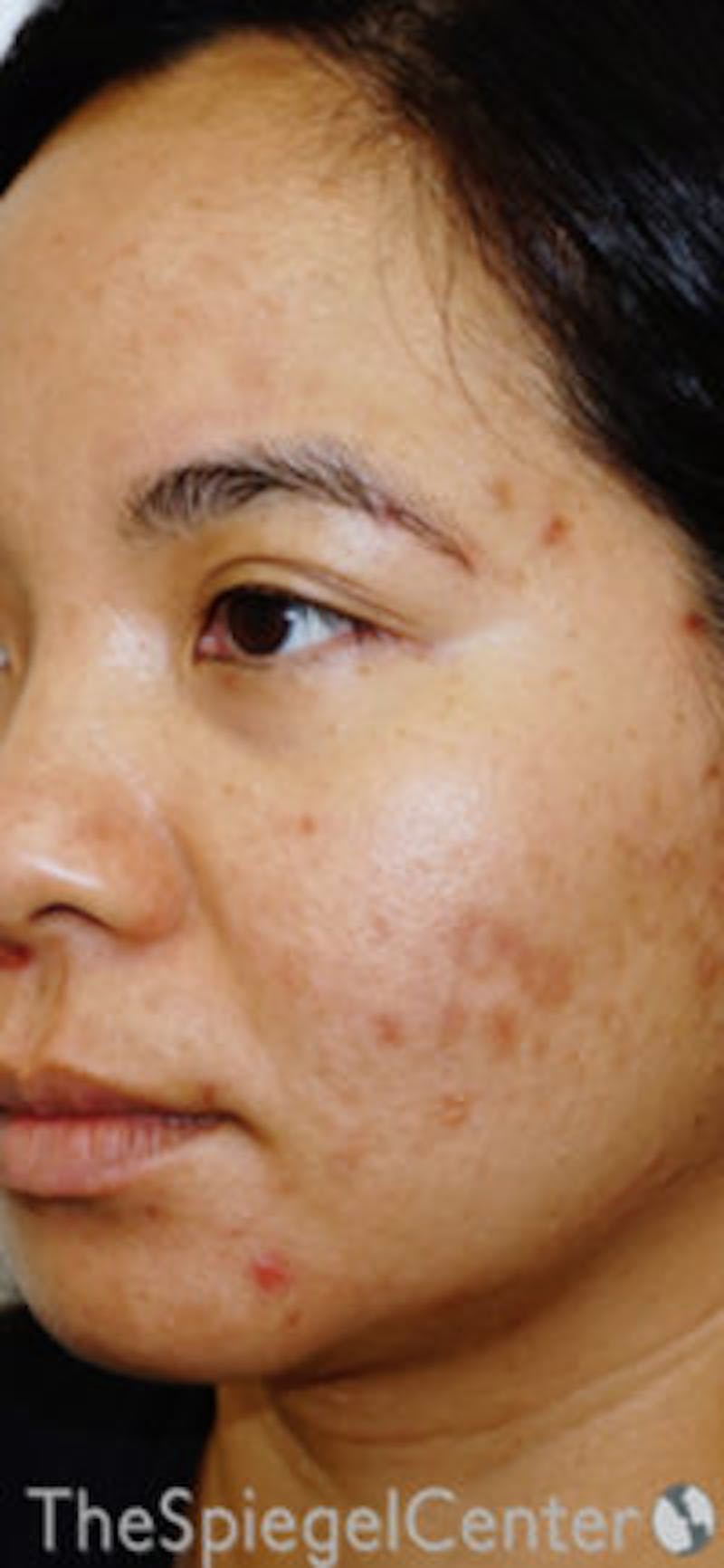 IPL / Intense Pulse Light Before & After Gallery - Patient 157140391 - Image 1