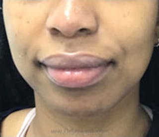 Chin Filler Before & After Gallery - Patient 157140393 - Image 2