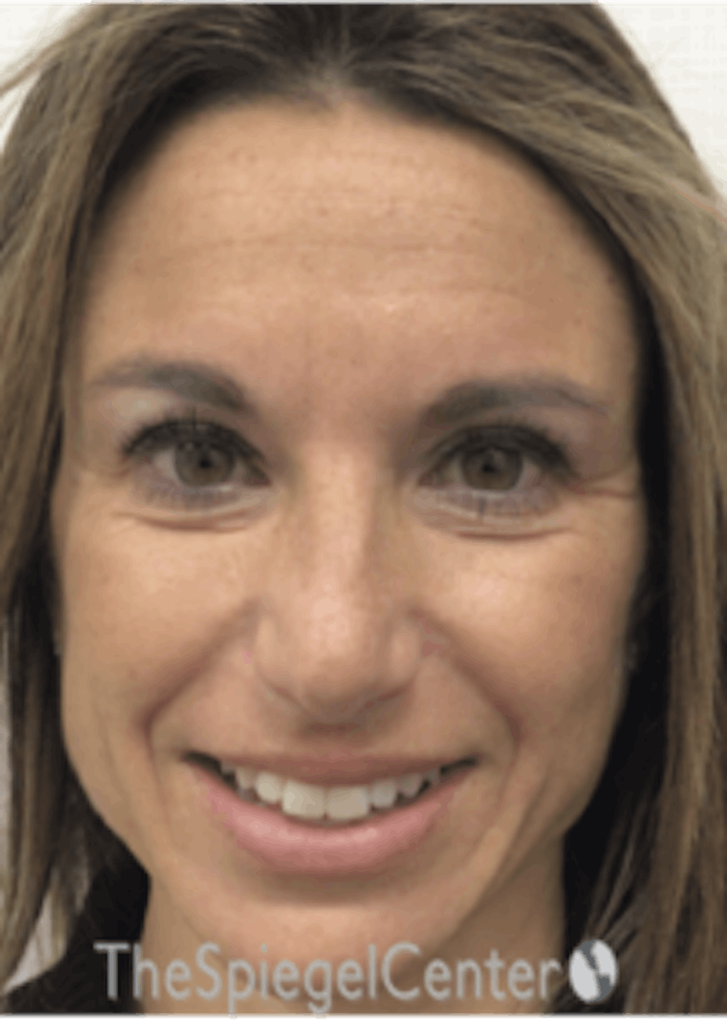 Botox / Dysport / Jeuveau / Xeomin Before & After Gallery - Patient 157140392 - Image 5