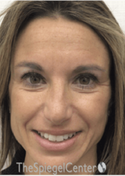 Botox / Dysport / Jeuveau / Xeomin Before & After Gallery - Patient 157140392 - Image 5