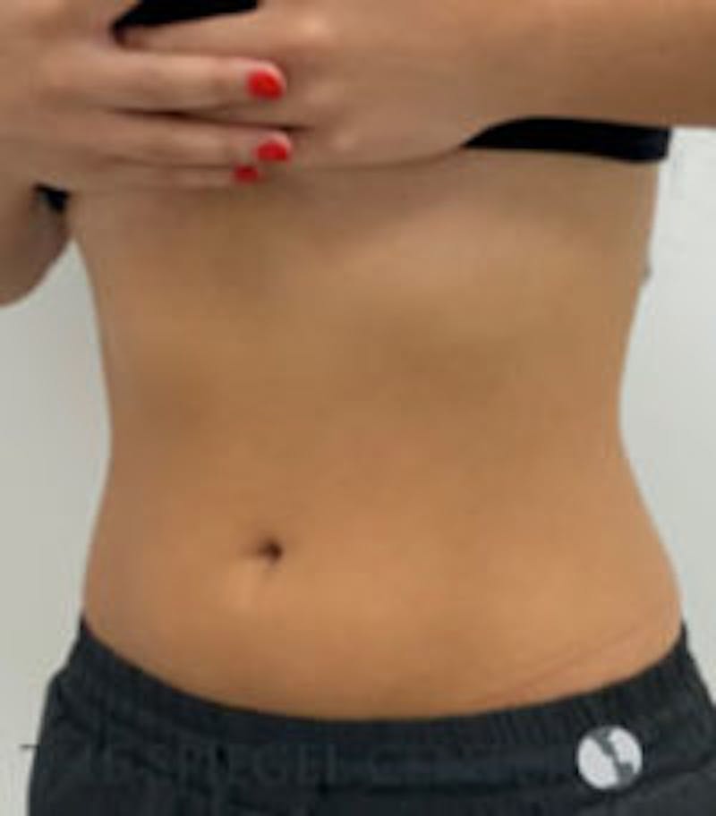 Fat Freezing Before & After Gallery - Patient 157140387 - Image 4