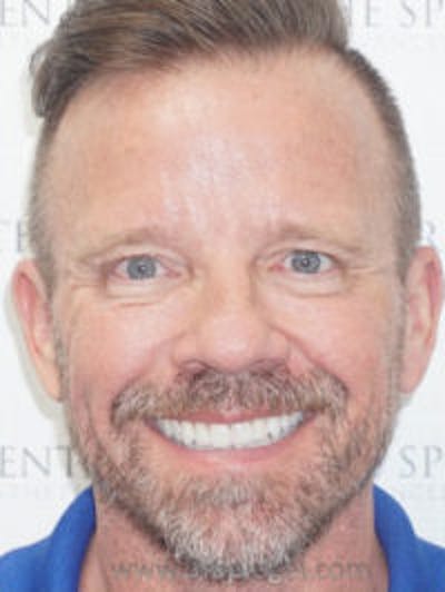 Liquid Face Lift Before & After Gallery - Patient 183935108 - Image 2