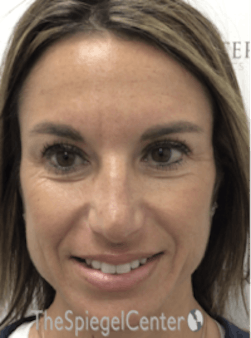 Botox / Dysport / Jeuveau / Xeomin Before & After Gallery - Patient 157140392 - Image 6