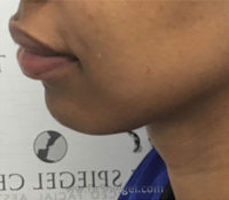 Chin Filler Before & After Gallery - Patient 157140393 - Image 4