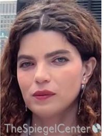 FFS Before & After Gallery - Patient 157140394 - Image 4