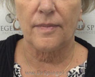Facetite / Necktite / Embrace / Accutite Before & After Gallery - Patient 157140400 - Image 2