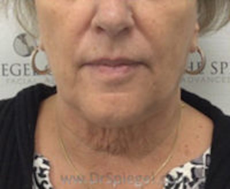 Facetite / Necktite / Embrace Before & After Gallery - Patient 157140400 - Image 2