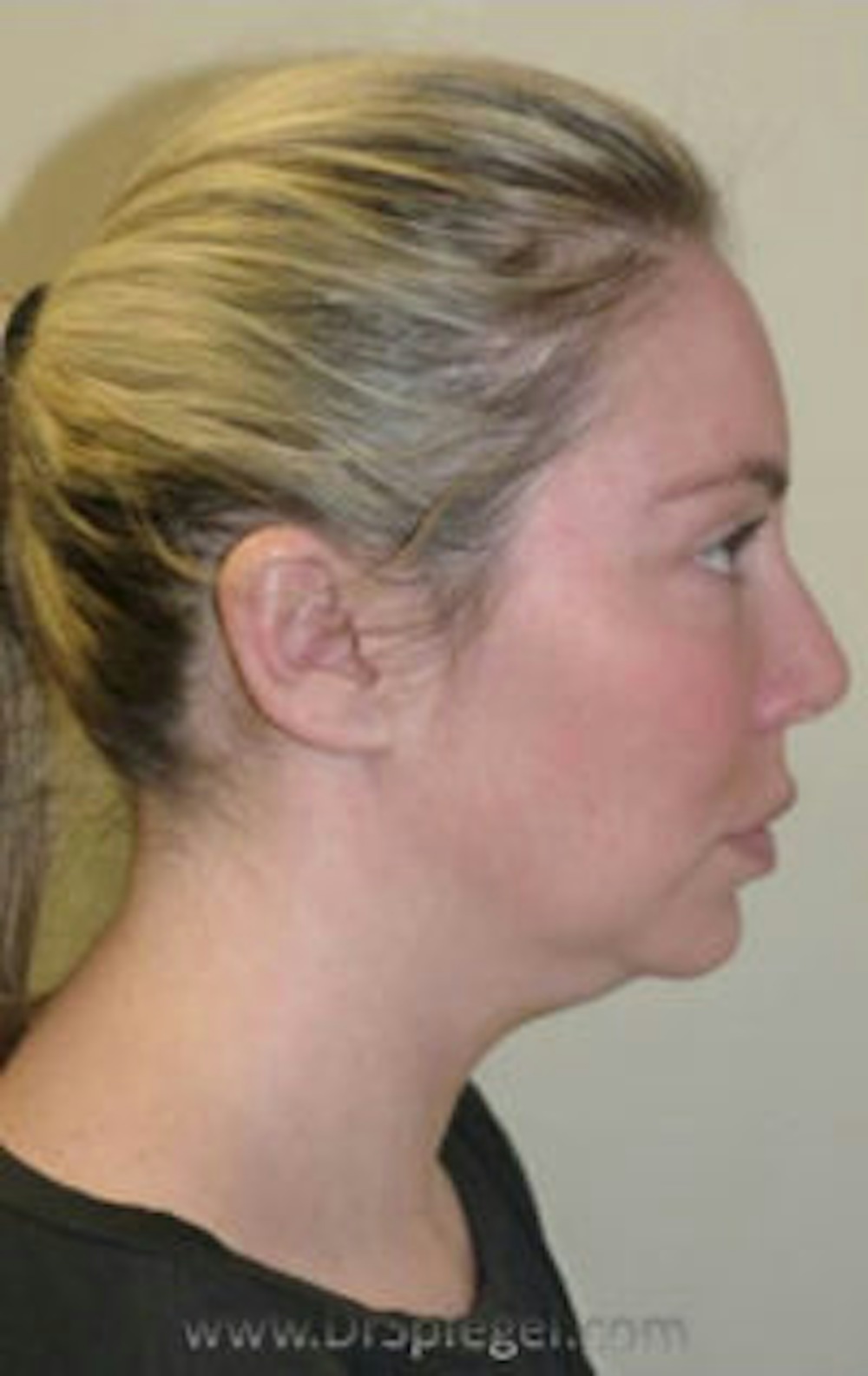Kybella