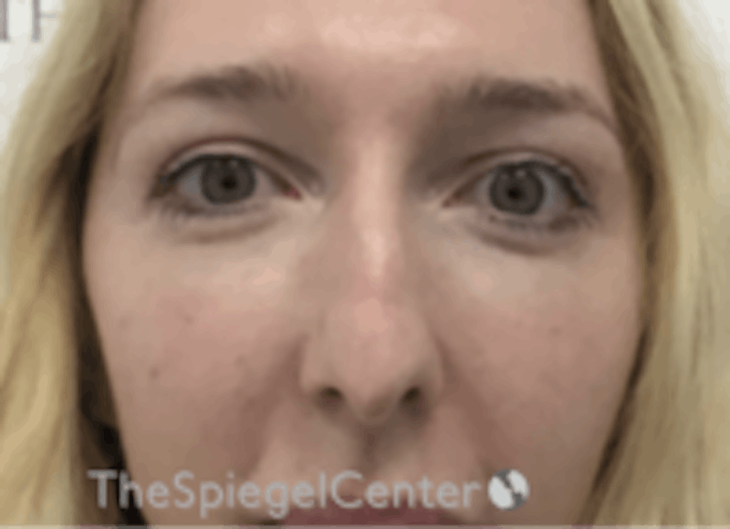 Rhinoplasty Before & After Gallery - Patient 157140412 - Image 3