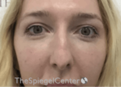 Rhinoplasty Before & After Gallery - Patient 157140412 - Image 3