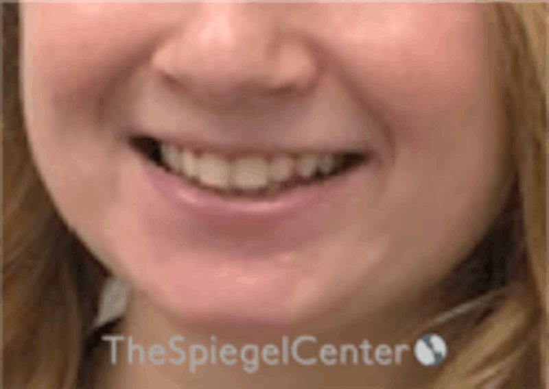 Lip Filler Before & After Gallery - Patient 157140419 - Image 1