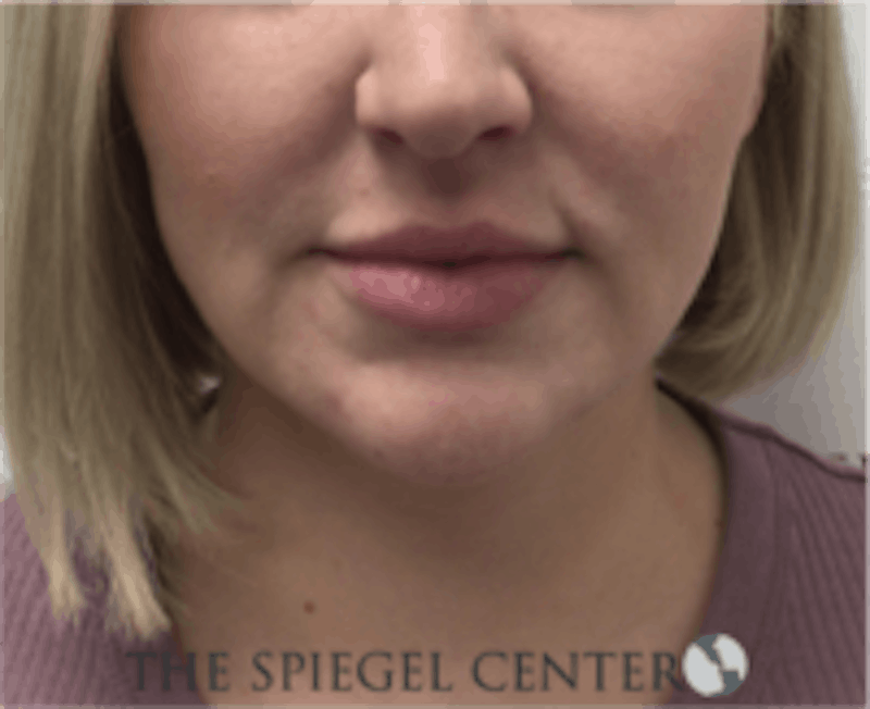 Facetite / Necktite / Embrace / Accutite Before & After Gallery - Patient 157140413 - Image 1