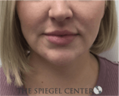 Facetite / Necktite / Embrace / Accutite Before & After Gallery - Patient 157140413 - Image 1