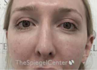 Rhinoplasty Before & After Gallery - Patient 157140412 - Image 4