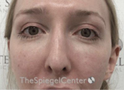 Rhinoplasty Before & After Gallery - Patient 157140412 - Image 4
