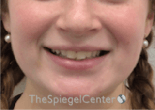 Lip Filler Before & After Gallery - Patient 157140419 - Image 2