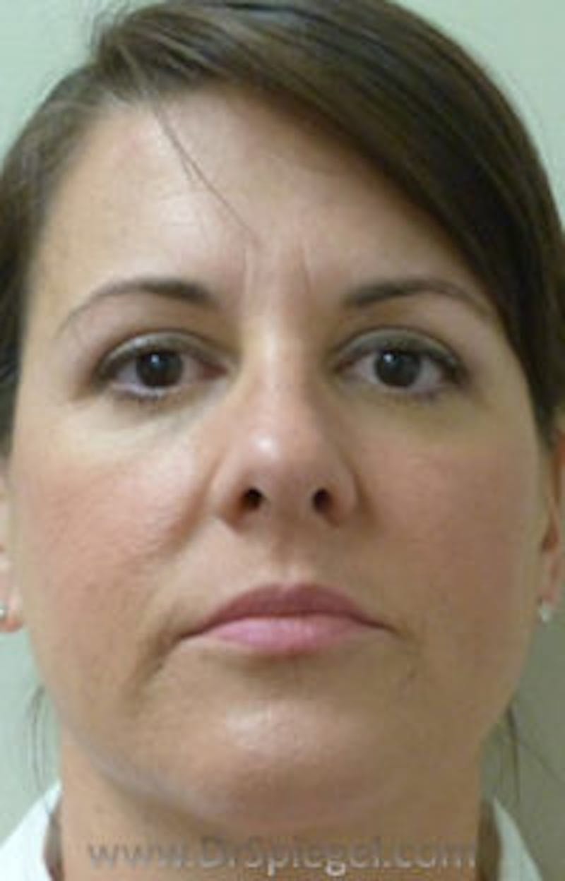 Liquid Face Lift Before & After Gallery - Patient 183935112 - Image 1