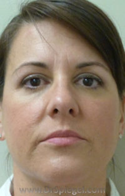 Liquid Face Lift Before & After Gallery - Patient 183935112 - Image 1