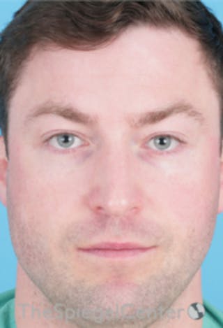 Botox / Dysport / Jeuveau / Xeomin Before & After Gallery - Patient 157140406 - Image 4