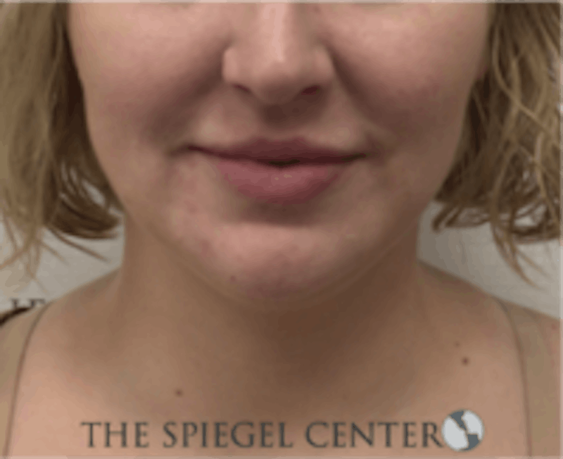 Facetite / Necktite / Embrace / Accutite Before & After Gallery - Patient 157140413 - Image 2