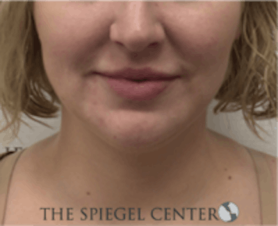 Facetite / Necktite / Embrace / Accutite Before & After Gallery - Patient 157140413 - Image 2