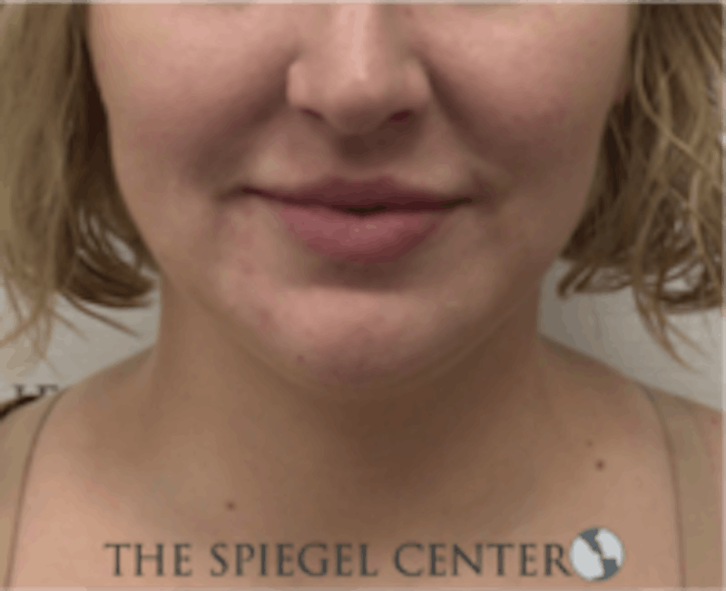 Facetite / Necktite / Embrace Before & After Gallery - Patient 157140413 - Image 2