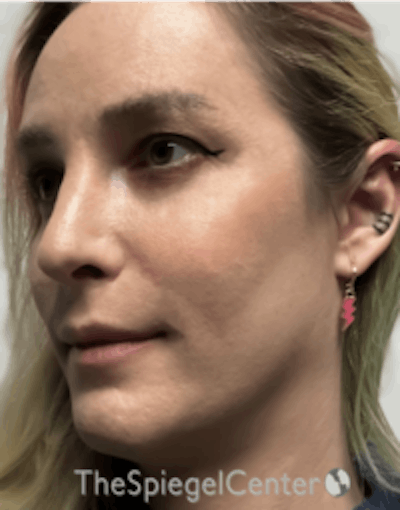 FFS Before & After Gallery - Patient 157140407 - Image 4