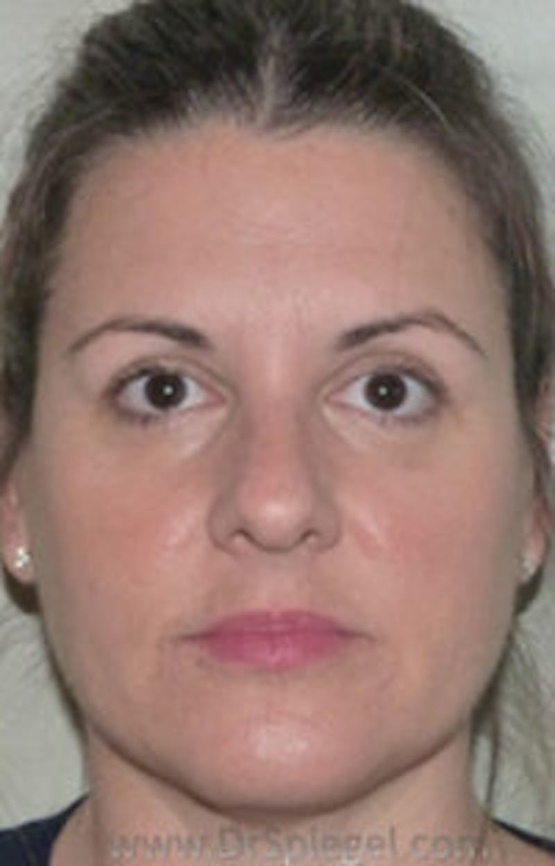 Liquid Face Lift Before & After Gallery - Patient 183935112 - Image 2