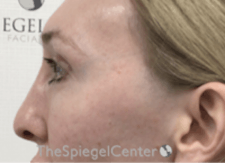 Rhinoplasty Before & After Gallery - Patient 157140412 - Image 2