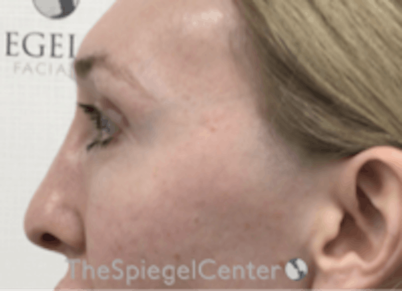 Rhinoplasty Before & After Gallery - Patient 157140412 - Image 2