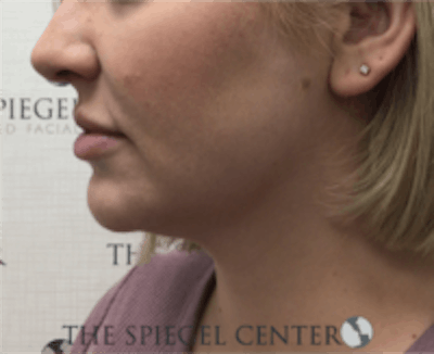 Facetite / Necktite / Embrace / Accutite Before & After Gallery - Patient 157140413 - Image 3