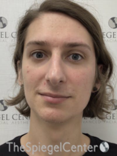 FFS Before & After Gallery - Patient 157140426 - Image 1