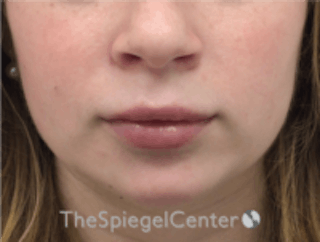 Lip Filler Before & After Gallery - Patient 157140419 - Image 4