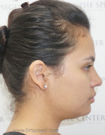 Kybella Before & After Gallery - Patient 157140414 - Image 1