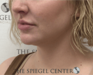 Facetite / Necktite / Embrace / Accutite Before & After Gallery - Patient 157140413 - Image 4