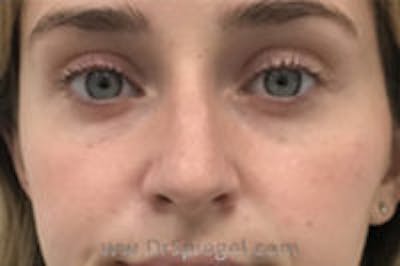 Rhinoplasty Before & After Gallery - Patient 157140422 - Image 3