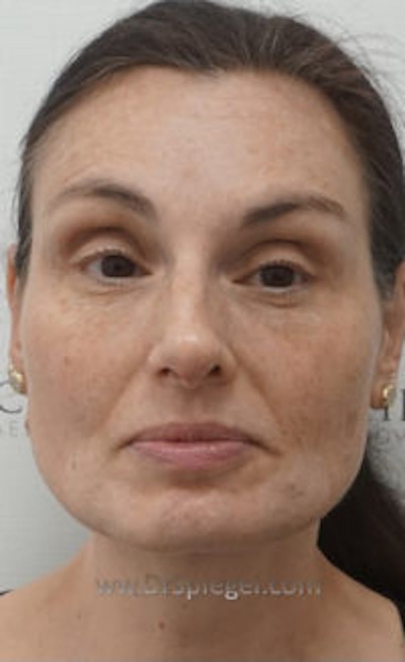 IPL / Intense Pulse Light Before & After Gallery - Patient 157140417 - Image 1