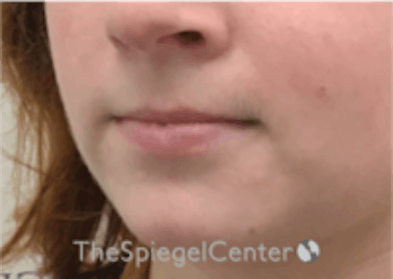 Lip Filler Before & After Gallery - Patient 157140419 - Image 5