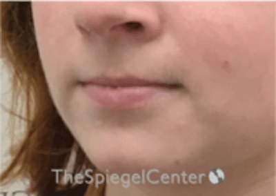 Lip Filler Before & After Gallery - Patient 157140419 - Image 5