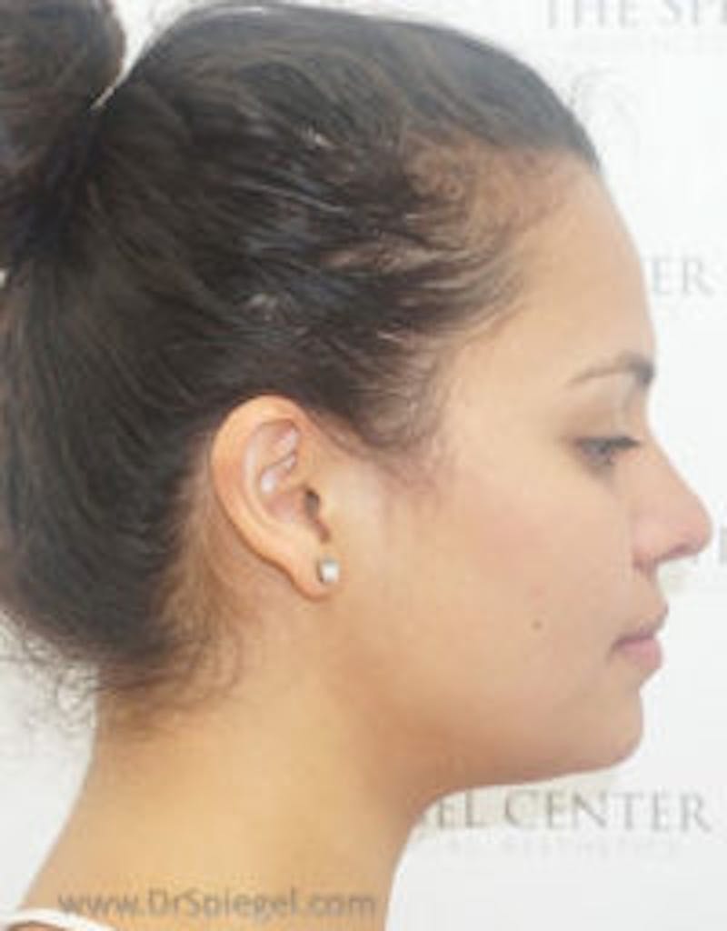 Kybella Before & After Gallery - Patient 157140414 - Image 2